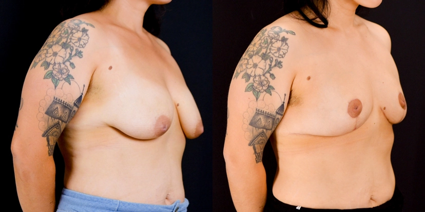 gallery-breast-lift-case-1-schmitt-plastic-surgery-2
