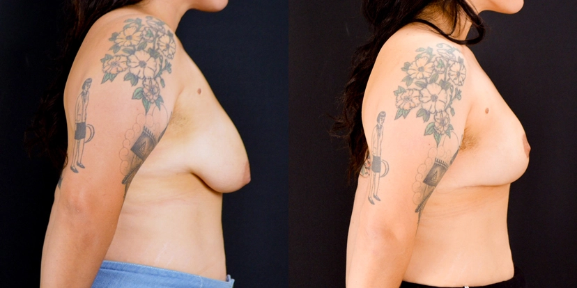 gallery-breast-lift-case-1-schmitt-plastic-surgery-3