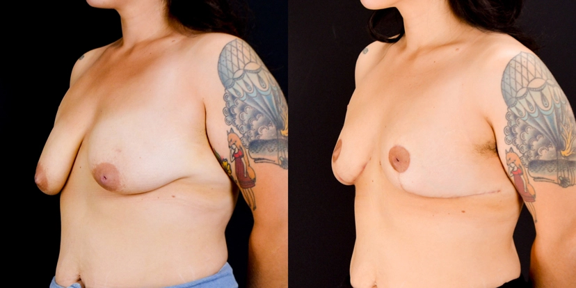 gallery-breast-lift-case-1-schmitt-plastic-surgery-4