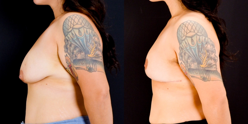 gallery-breast-lift-case-1-schmitt-plastic-surgery-5