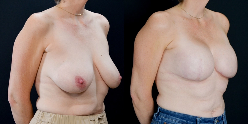 gallery-breast-reconstruction-before-after-case-1-schmitt-plastic-surgery2
