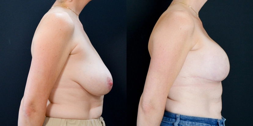 gallery-breast-reconstruction-before-after-case-1-schmitt-plastic-surgery3