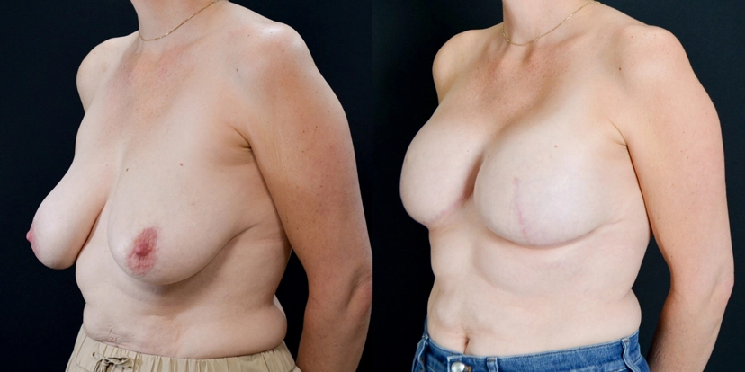 gallery-breast-reconstruction-before-after-case-1-schmitt-plastic-surgery4