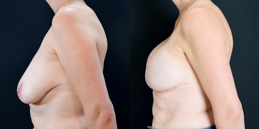 gallery-breast-reconstruction-before-after-case-1-schmitt-plastic-surgery5