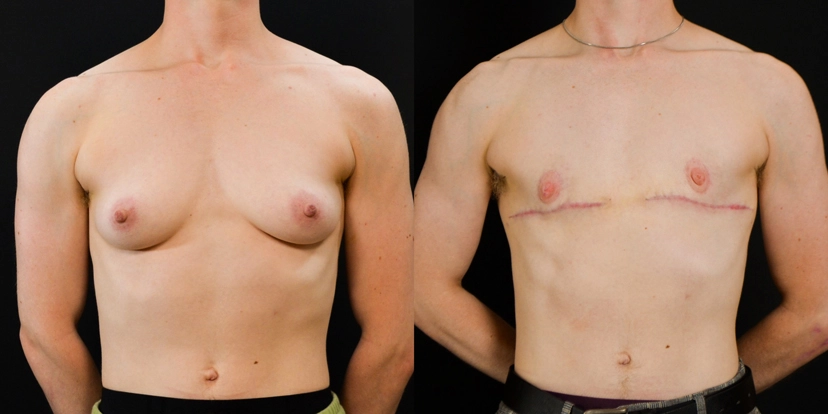 gallery-gender-affirming-before-after-case-1-schmitt-plastic-surgery1