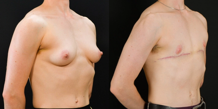 gallery-gender-affirming-before-after-case-1-schmitt-plastic-surgery2
