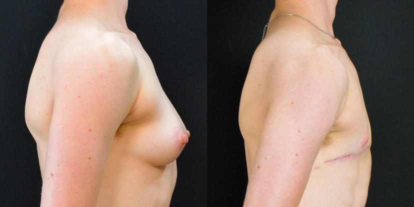 gallery-gender-affirming-before-after-case-1-schmitt-plastic-surgery3