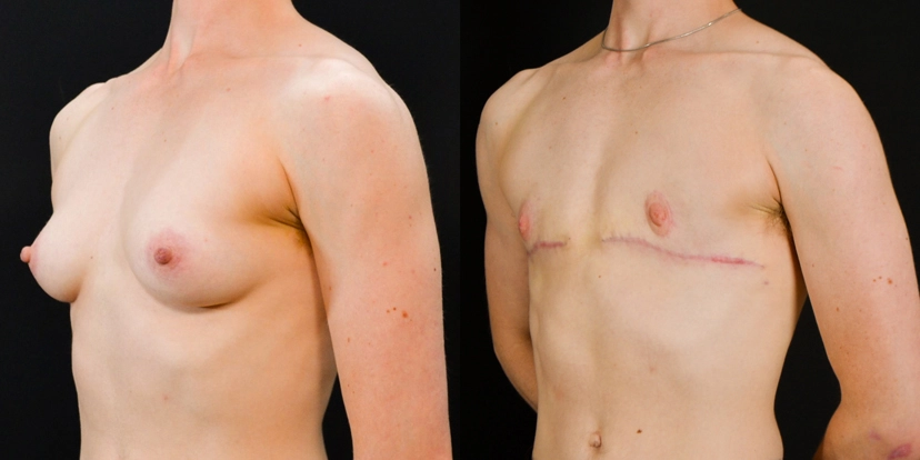 gallery-gender-affirming-before-after-case-1-schmitt-plastic-surgery4