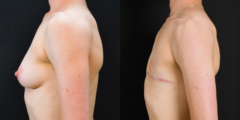 gallery-gender-affirming-before-after-case-1-schmitt-plastic-surgery5