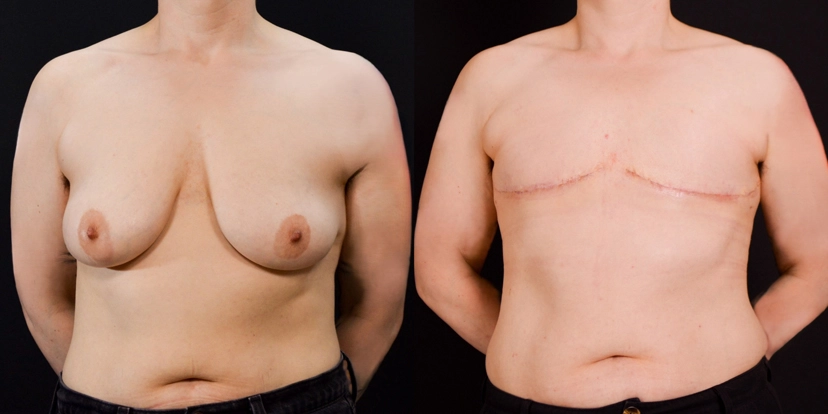 gallery-gender-affirming-before-after-case-2-schmitt-plastic-surgery1