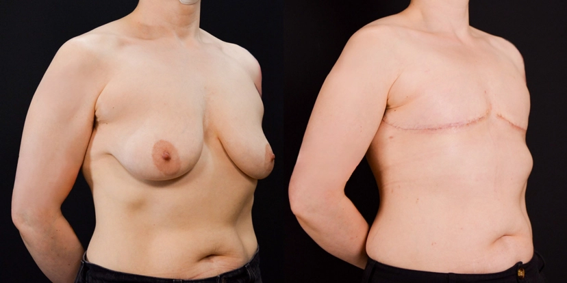 gallery-gender-affirming-before-after-case-2-schmitt-plastic-surgery2