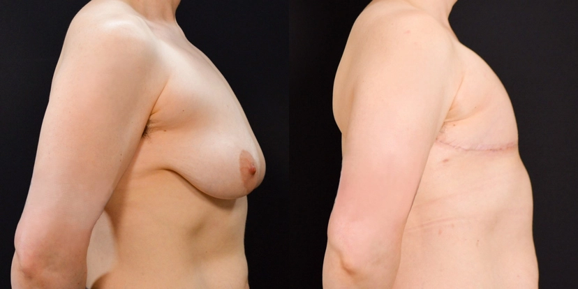 gallery-gender-affirming-before-after-case-2-schmitt-plastic-surgery3