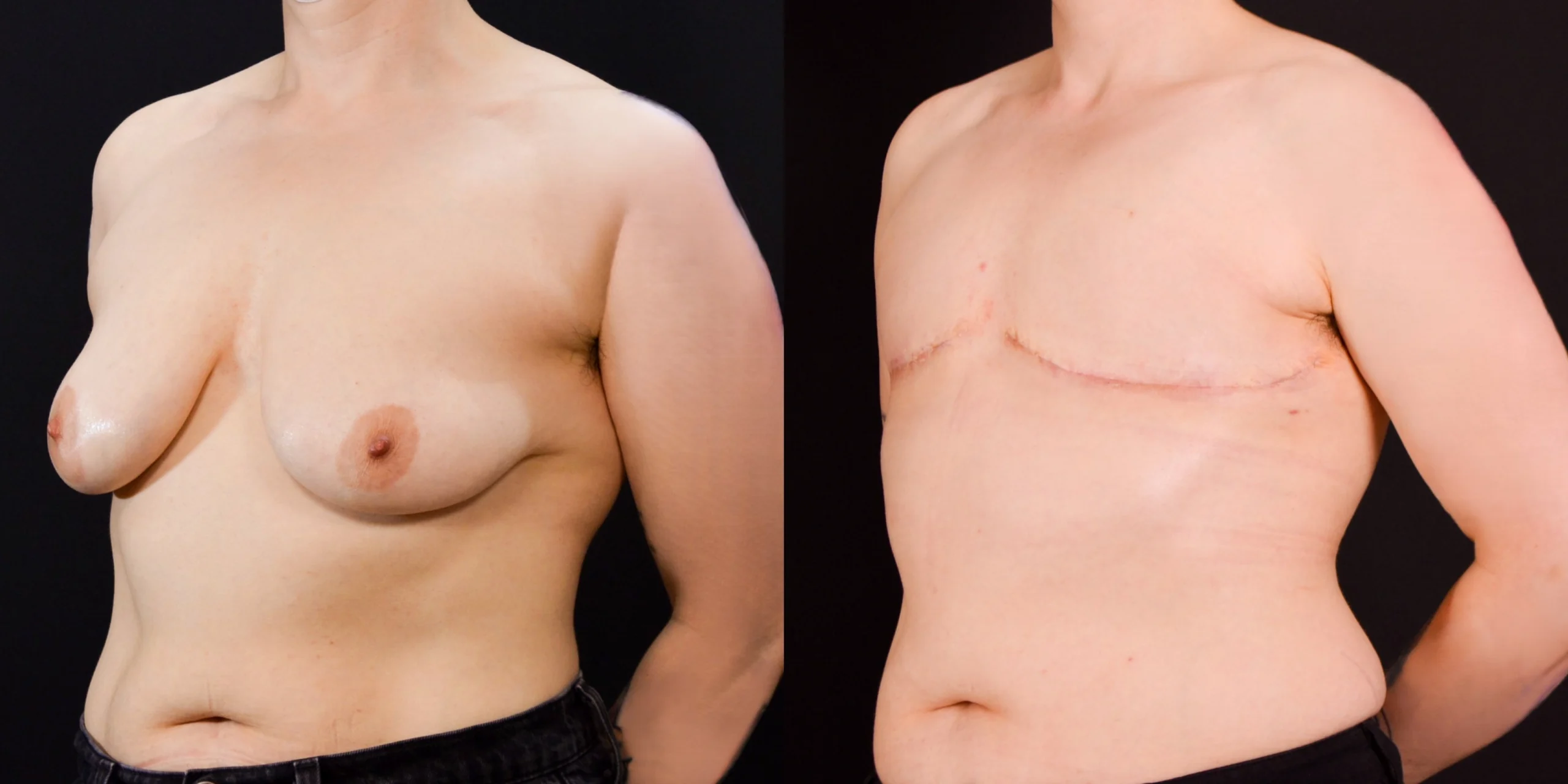 gallery-gender-affirming-before-after-case-2-schmitt-plastic-surgery4