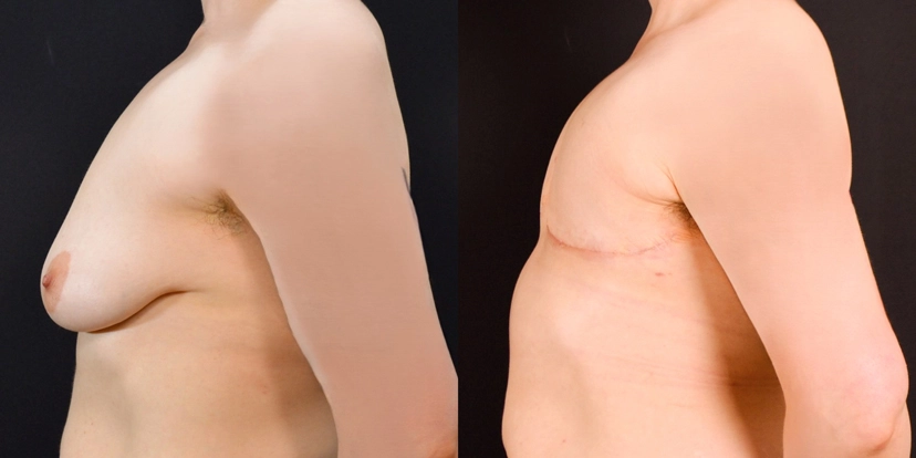 gallery-gender-affirming-before-after-case-2-schmitt-plastic-surgery5