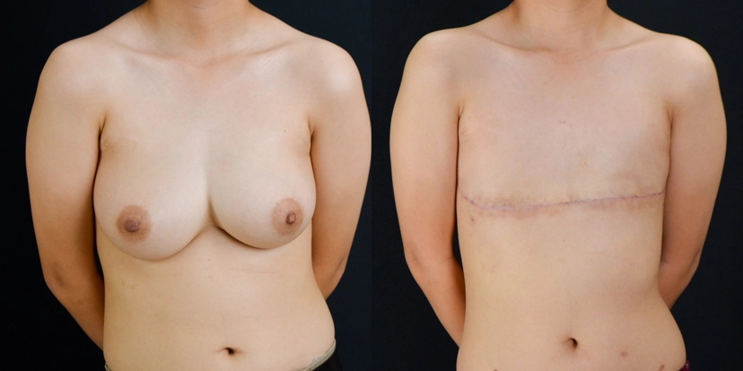 gallery-gender-affirming-before-after-case-3-schmitt-plastic-surgery1