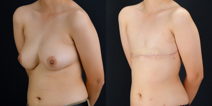 gallery-gender-affirming-before-after-case-3-schmitt-plastic-surgery4