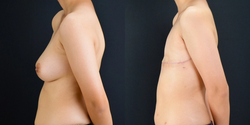 gallery-gender-affirming-before-after-case-3-schmitt-plastic-surgery5